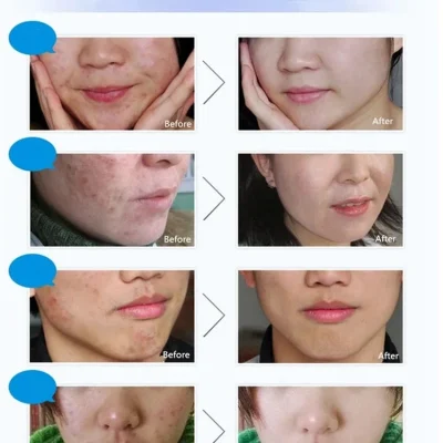 Bioaqua Acne Kit - [4 in 1] Girlsbeauty.pk